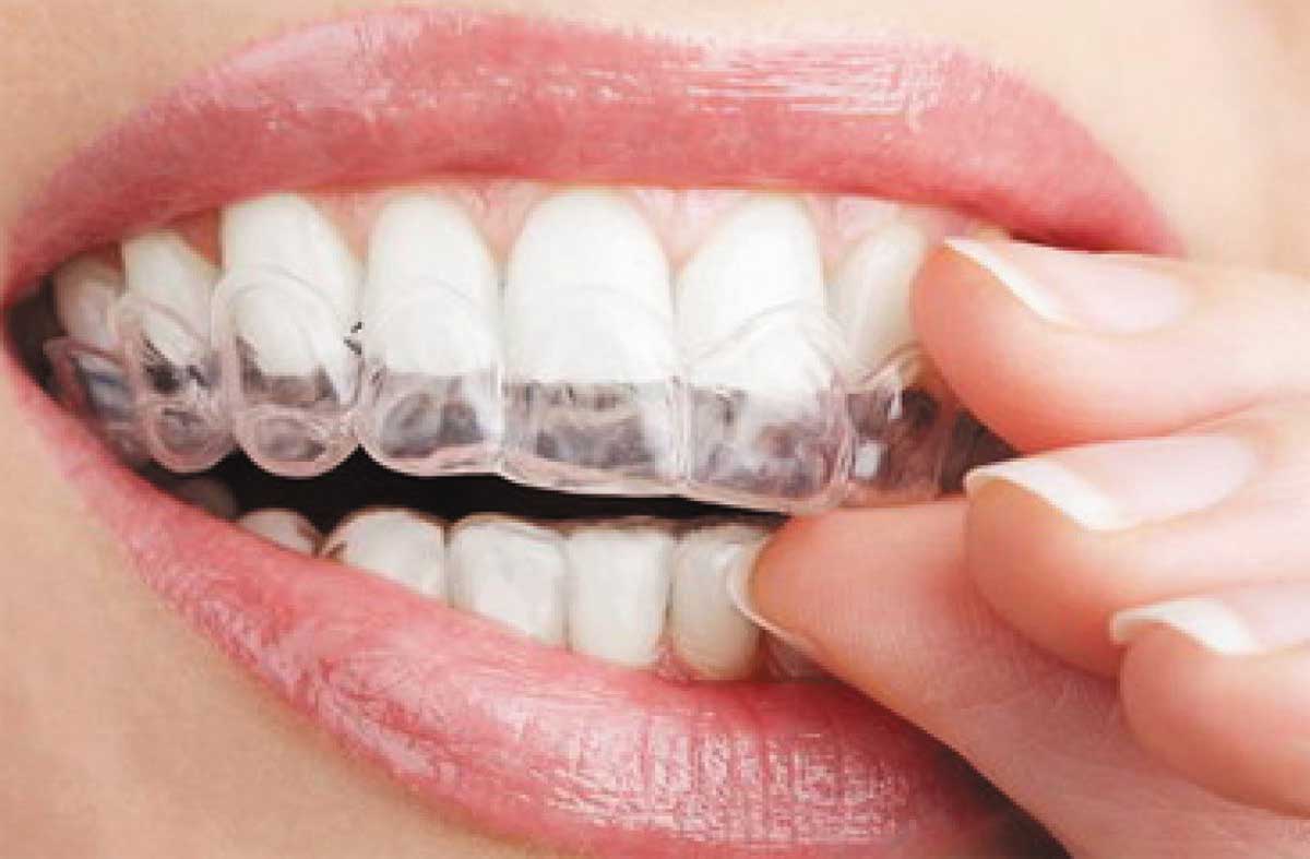Инновационное решение для ровных зубов и красивой улыбки